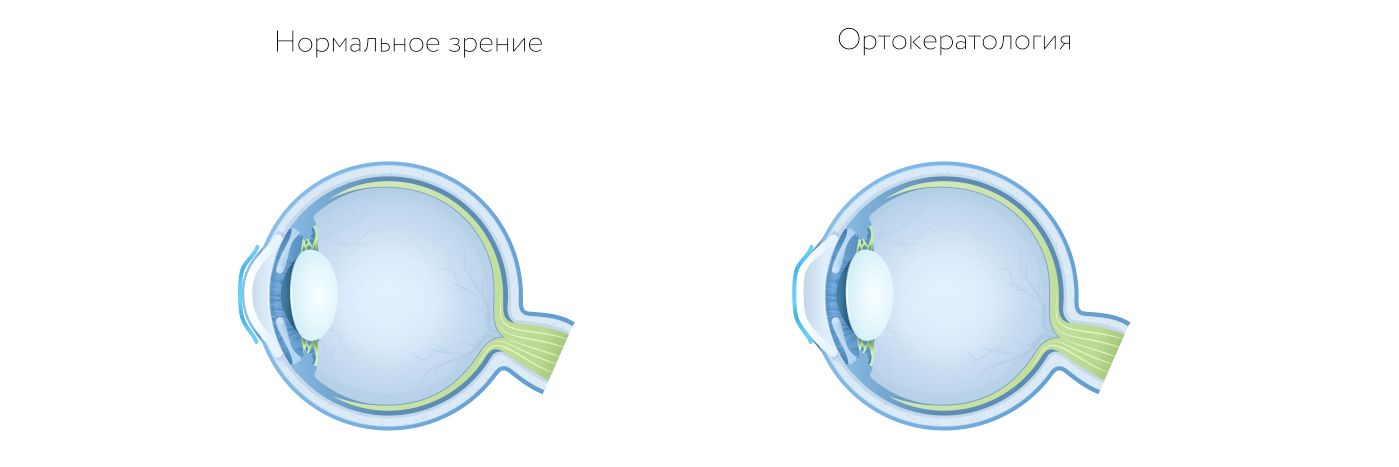 Ортокератология