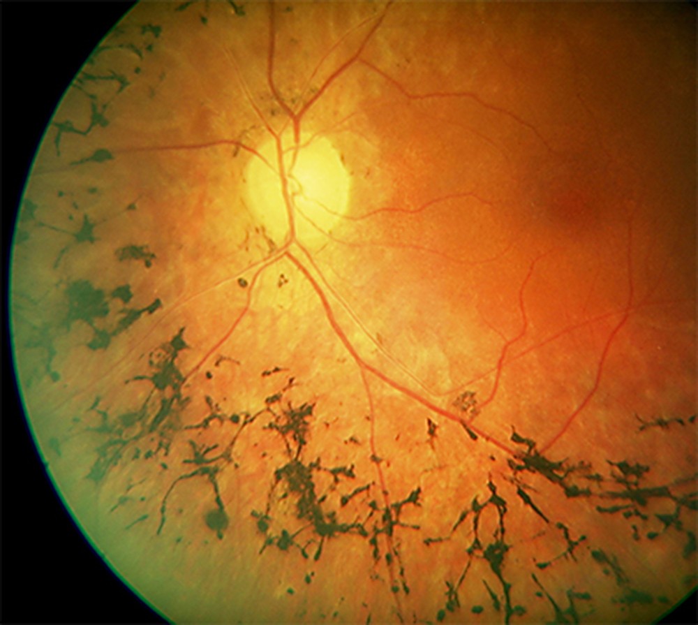 Пигментная дистрофия сетчатки