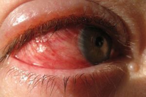 Почему опух и покраснел глаз