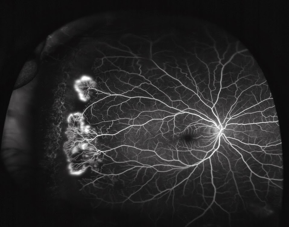 Флуоресцентная ангиография