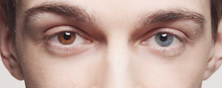 Что такое гетерохромия глаз