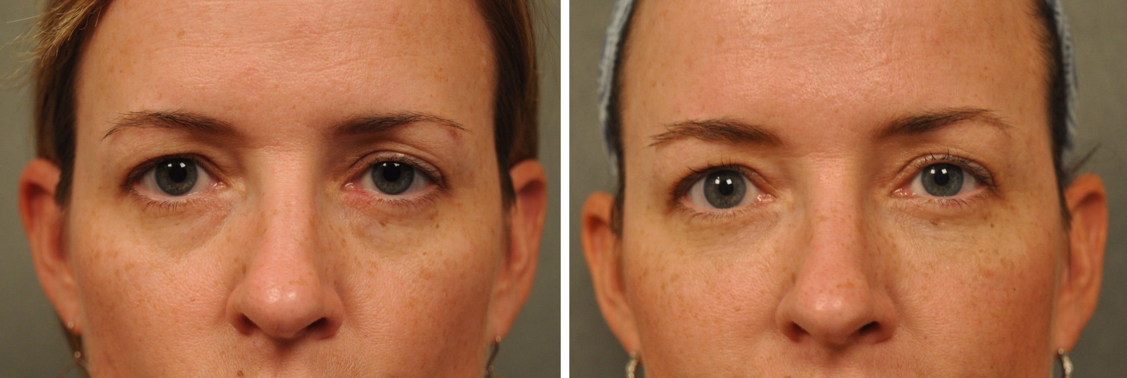 Как убрать слезную борозду под глазами