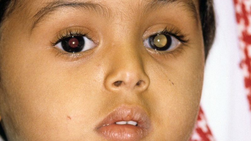 Ретинобластома - рак сетчатки глаза