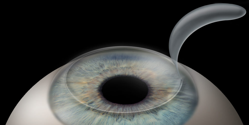 Лазерная коррекция зрения методом Lasik (Ласик)