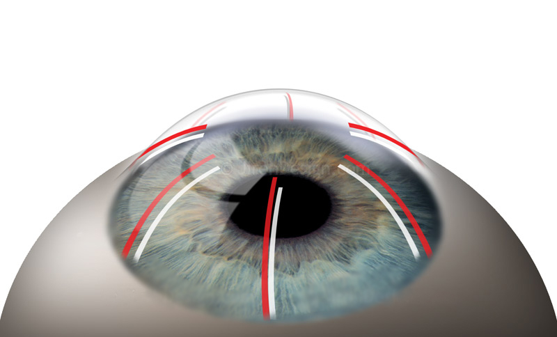 Кератотомия