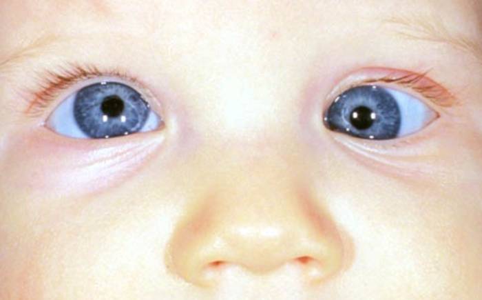 косоглазие