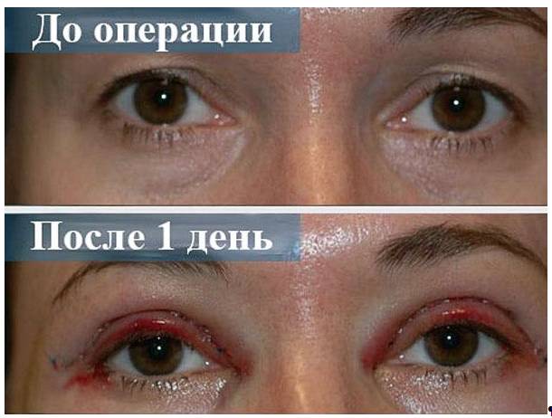 Сколько времени занимает полное восстановление после блефаропластики