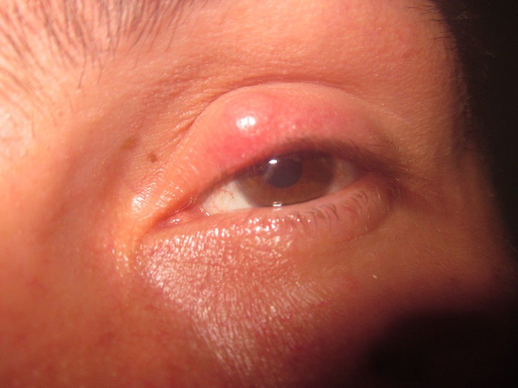 Почему остается шишка