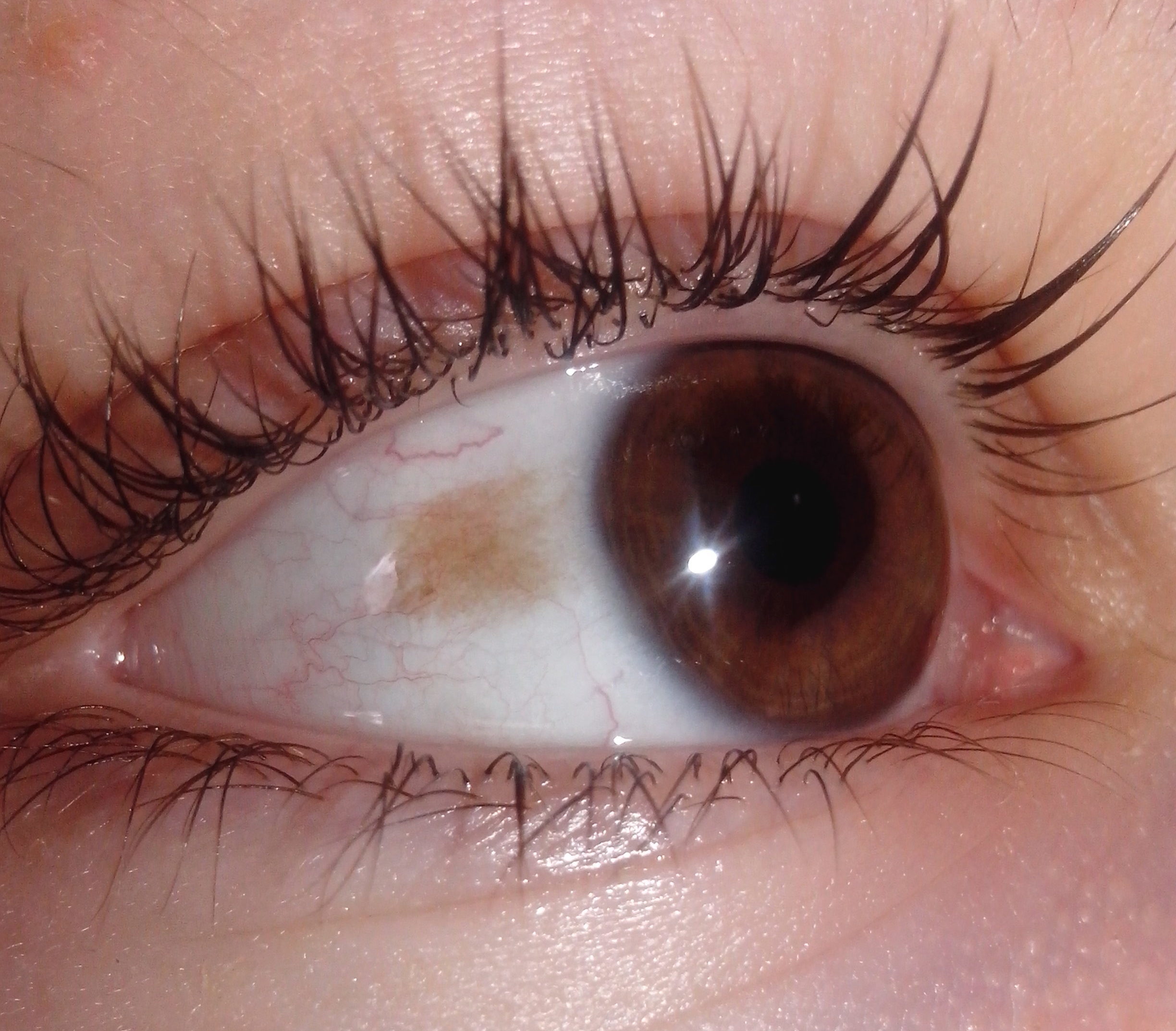 zheltoe-pyatno-na-belke-glaza