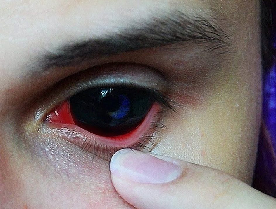 Почему стоит отдать предпочтение склерам на заказ