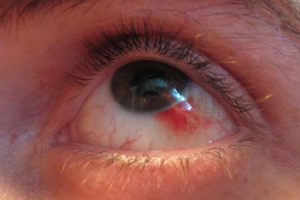 Гемофтальм