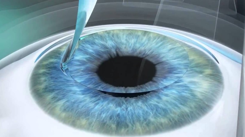 Лазерная коррекция зрения методом Super Lasik (Супер Ласик)