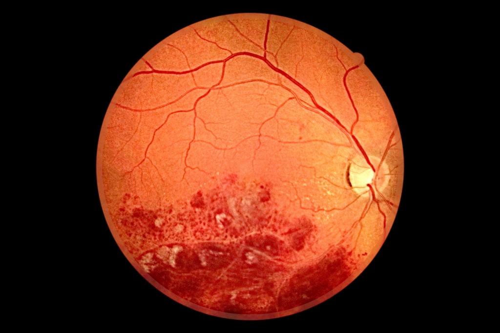 Тромбоз центральной вены сетчатки глаза