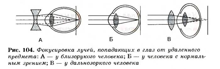 Что такое аметропия глаза