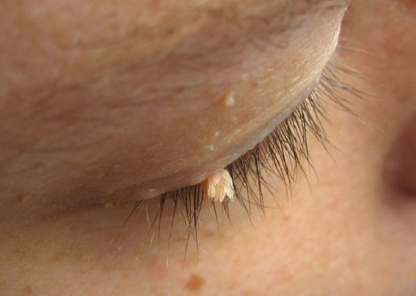 Злокачественные наросты