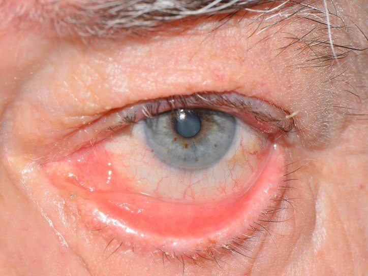 воспаление глаз