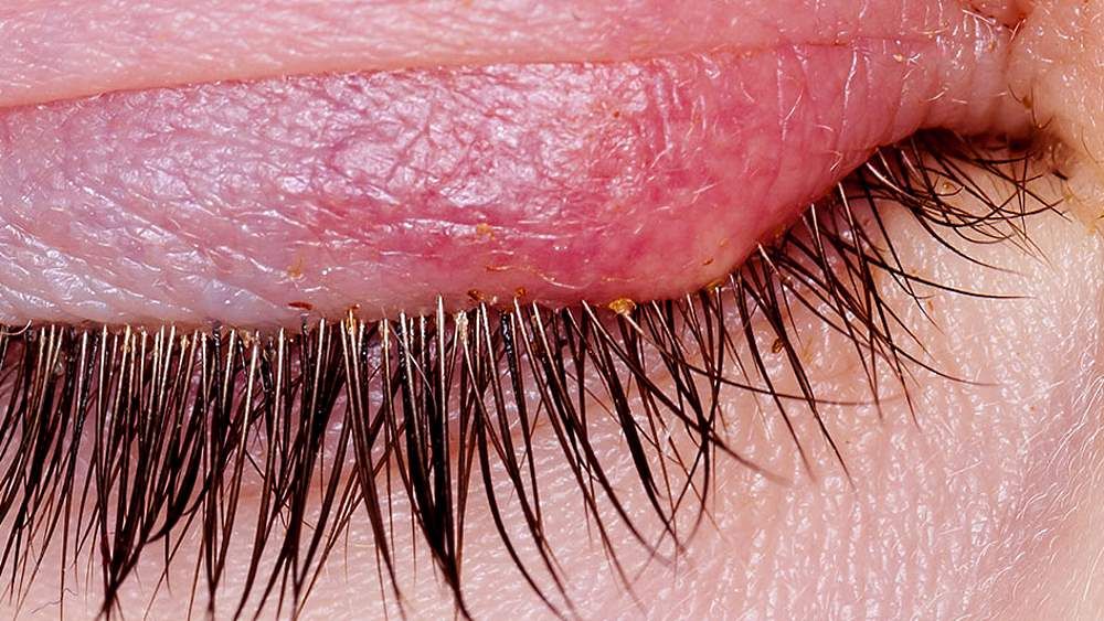 Откуда появляется ячмень