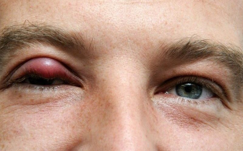 Заразность ячменя