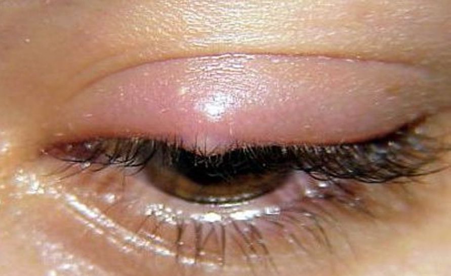 Что такое ячмень