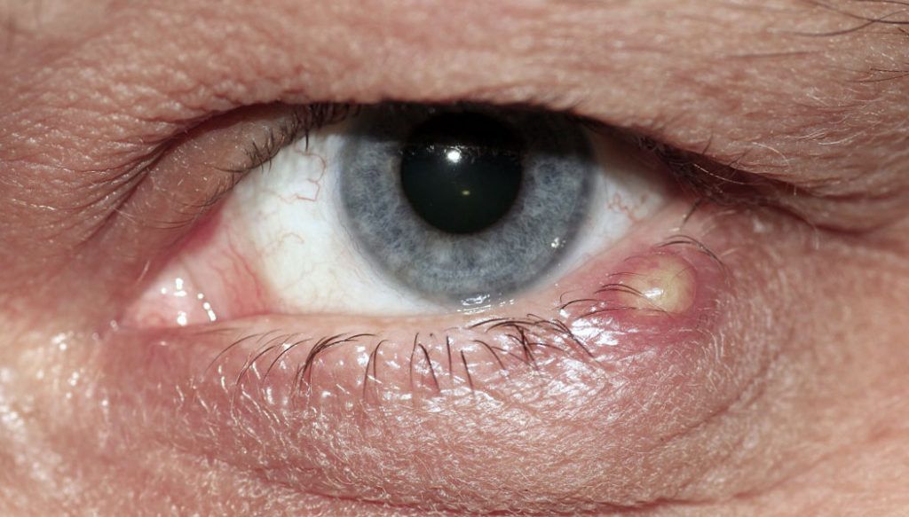 Последняя стадия — вскрытие гнойной головки