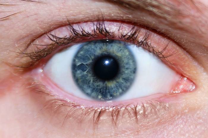 Кератопатия роговицы глаза