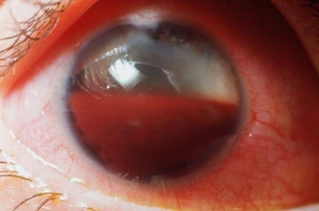 Гифема или кровоизлияние в переднюю камеру глаза