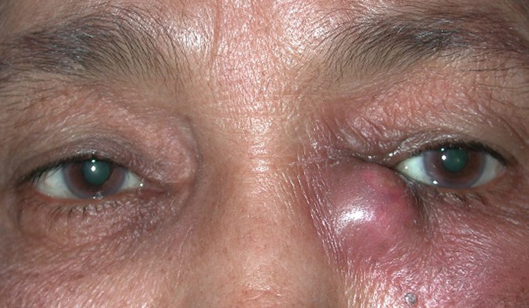 дакриоцистит