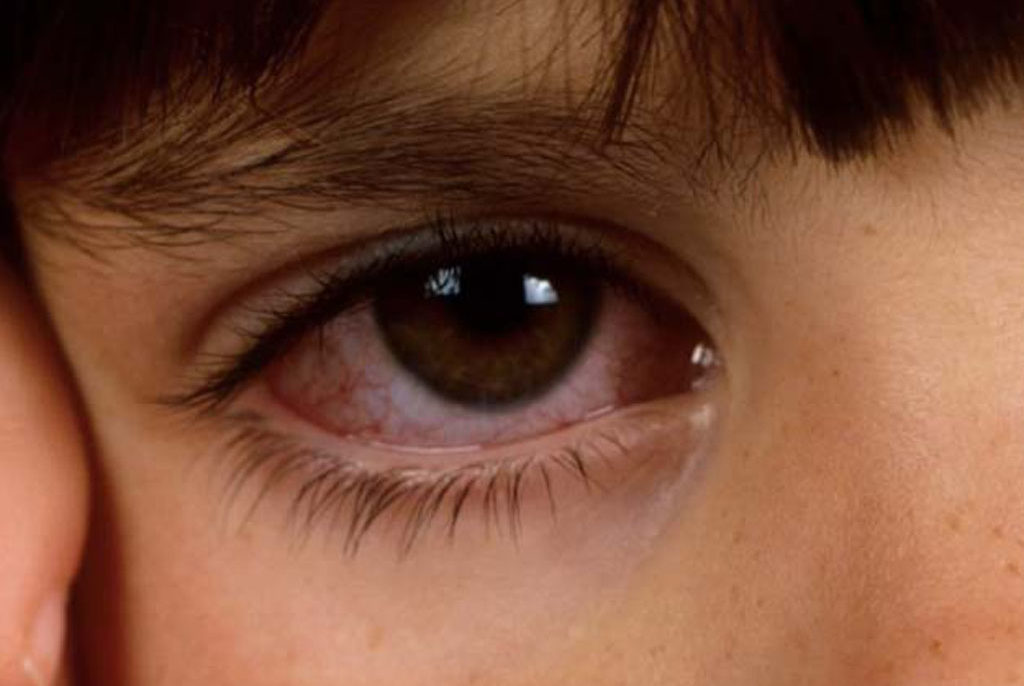 Комаровский о лечении конъюнктивита у детей