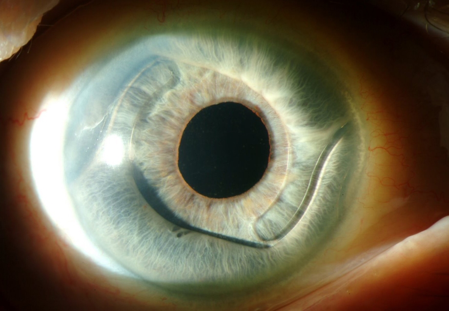 Артифакия глаза