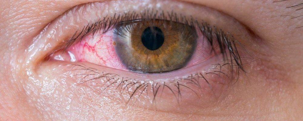 Грибок глаз