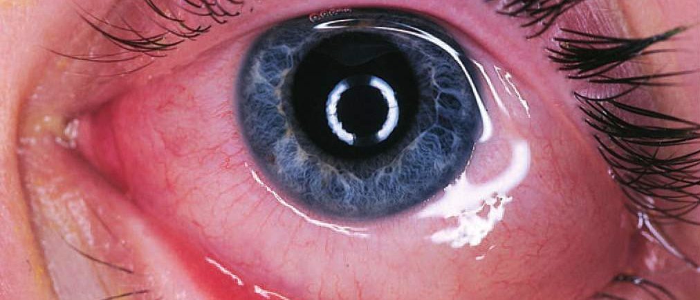 красный глаз