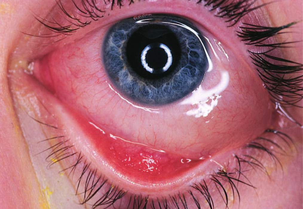 Хемоз конъюнктивы