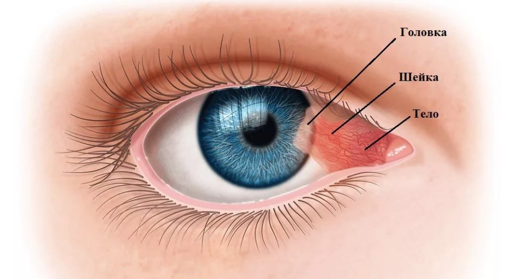 Что такое птеригиум