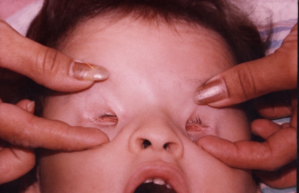 Анофтальм или отсутствие глазного яблока