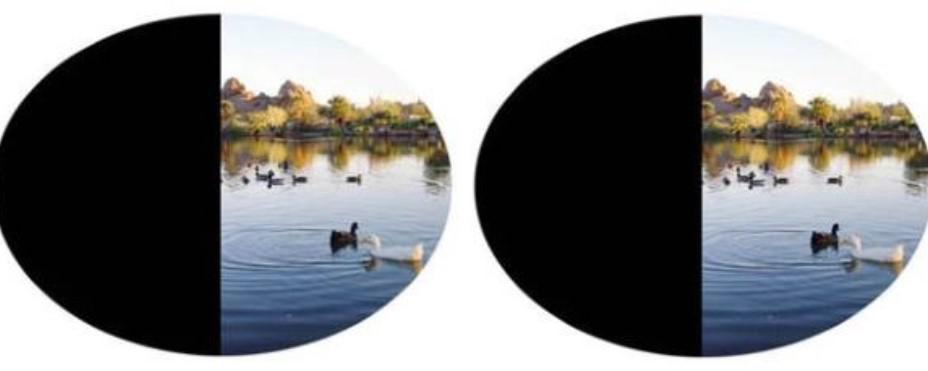 Выпадение полей зрения