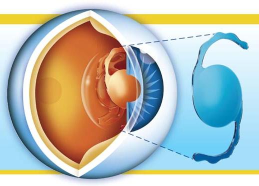 Артифакия глаза