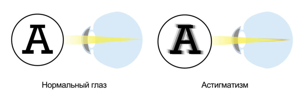 Классификация видов астигматизма