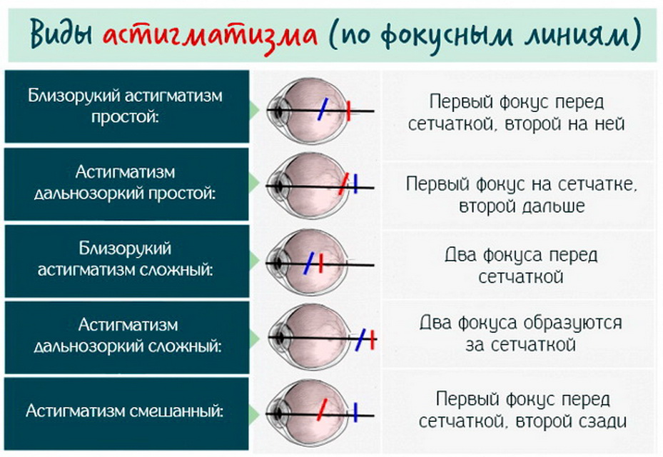 Что такое сложный астигматизм