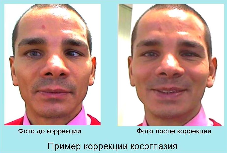 Виды операций на косоглазие