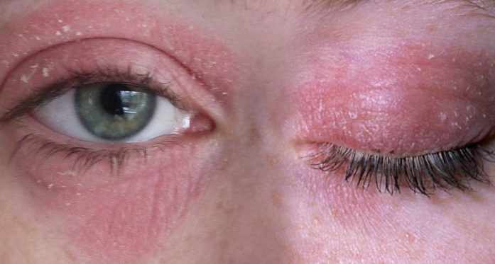 Нейродермит