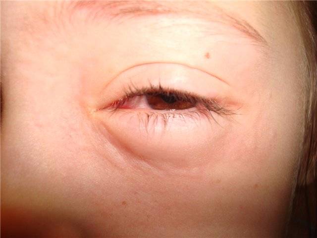 Как снять аллергический отек с глаз - что делать
