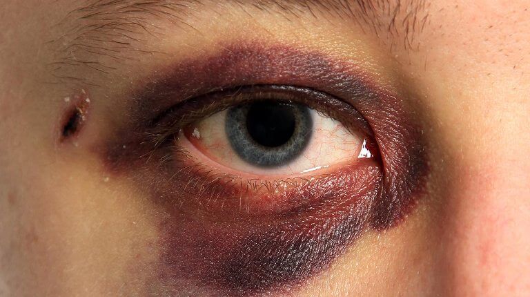 Как долго проходит синяк под глазом - через какое время он исчезает