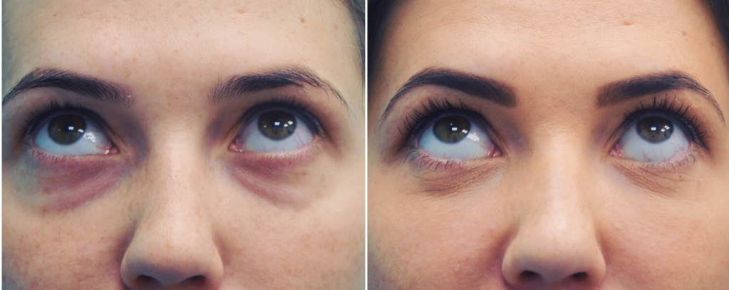 Лазерная блефаропластика - фото до и после