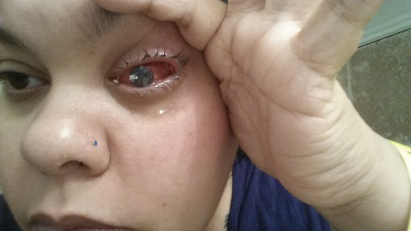 Что делать, если вытек глаз у человека