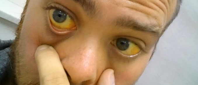Почему глаза становятся желтыми