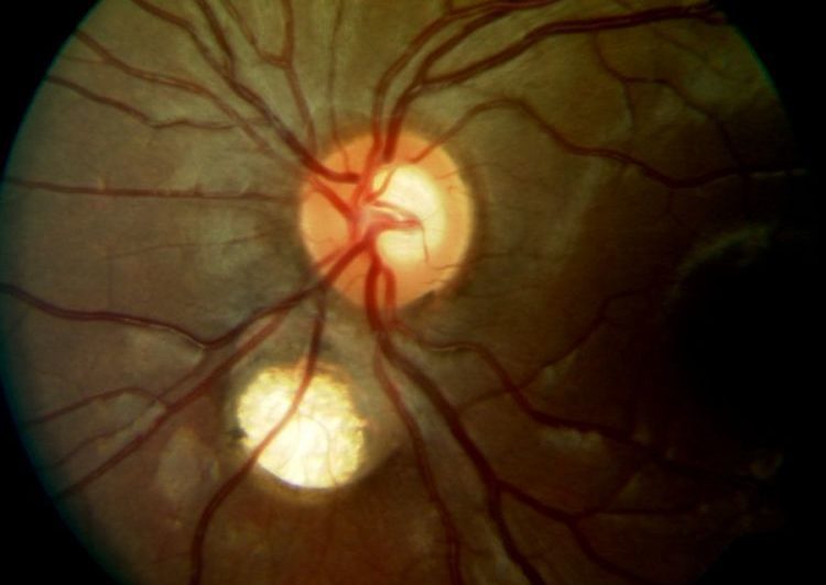 Колобома зрительного нерва