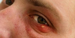 Может ли ячмень вызвать температуру