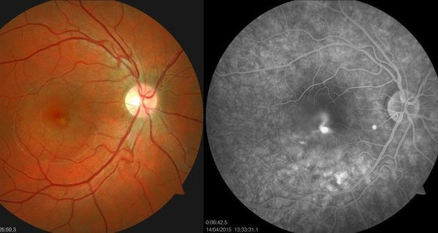 Центральная серозная хориоретинопатия (ЦСХ)