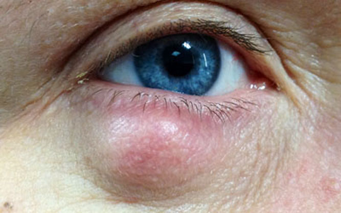 Осложнения