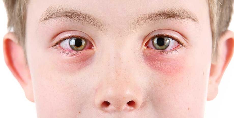 Аллергический конъюнктивит